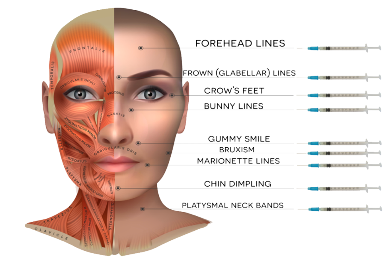 areas that can be treated with botox