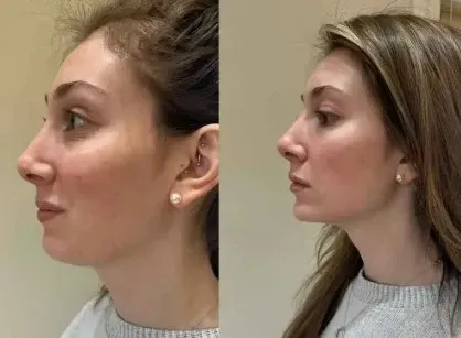 dermal filler before and after jawline enhancement