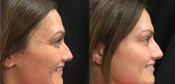 botox before and after result showing reduction of crows feet on womens face