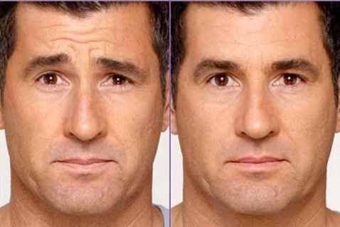 before and after result of botox showing reduction of forehead lines