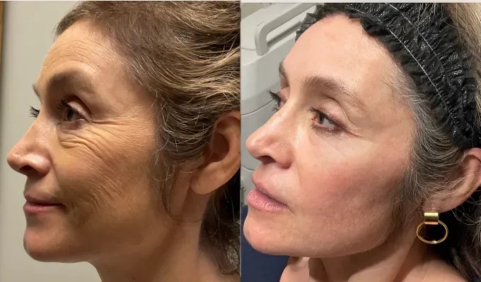 botox before after result showing reduction of wrinkle