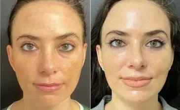 before after chemical peels session of our san marcos patient