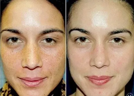 before and after image of chemical peel at the studio med spa