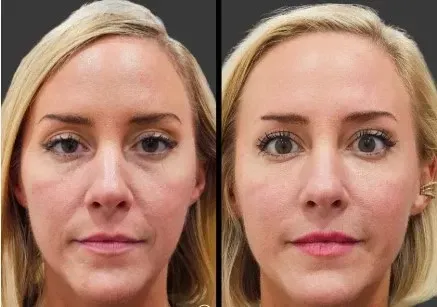 dermal filler before and after