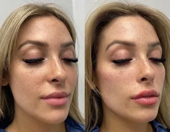 dermal filler before and after cheeks bone enhancement