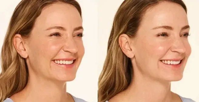 xeomin before after crows feet