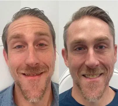 xeomin before after forehead lines