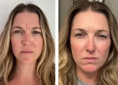 xeomin before after glabella