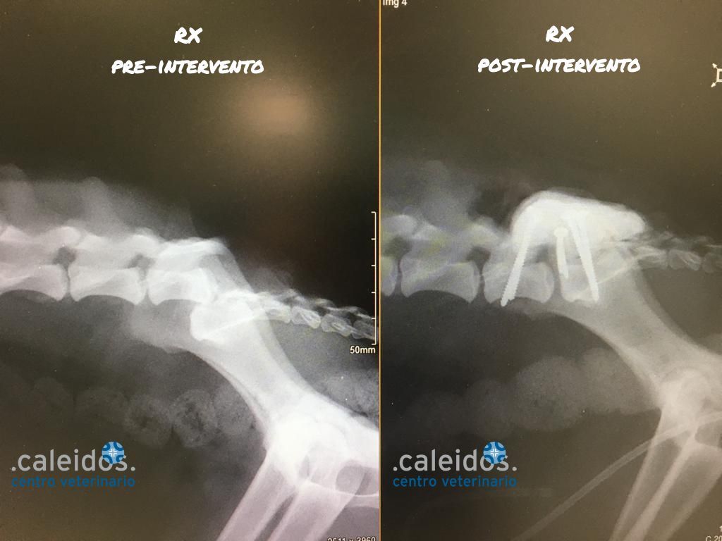 Intervento di stabilizzazione vertebrale in paraplegico per frattura vertebrale post trauma (cane investito)