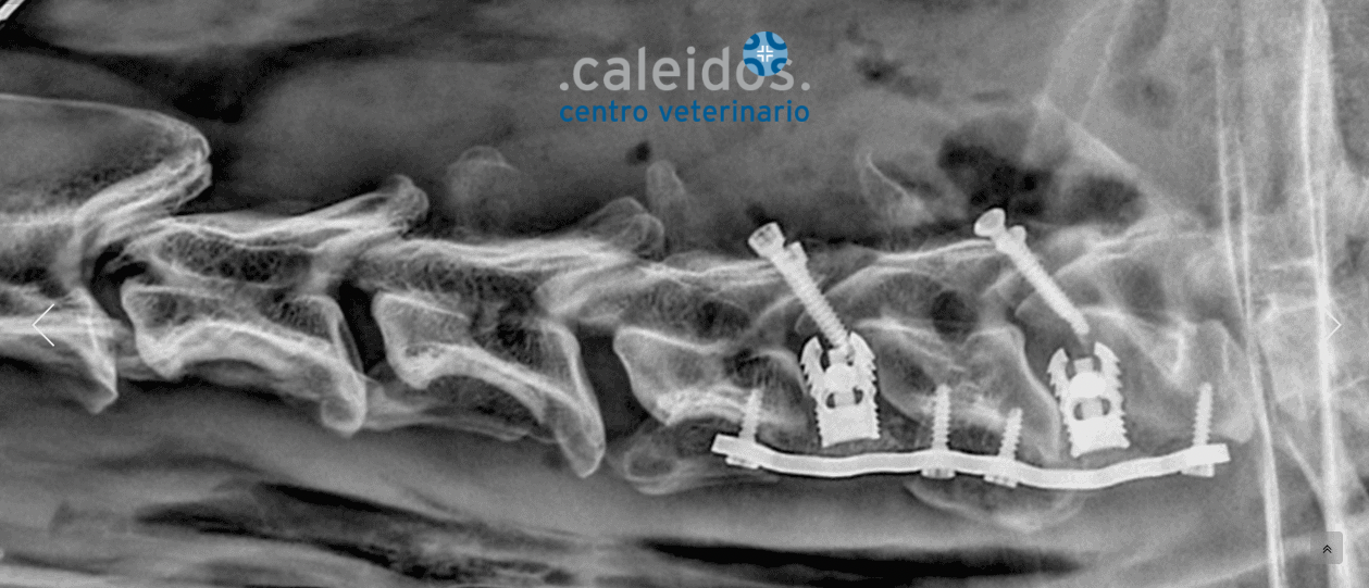Trattamento chirurgico della Sindrome di Wobbler