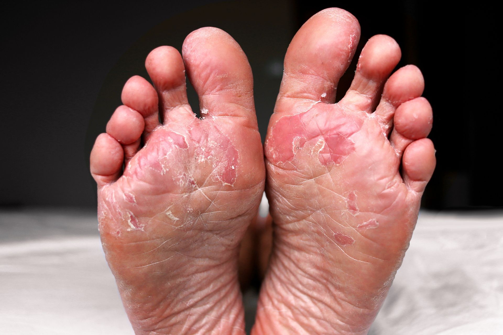 A close up of a person 's feet with peeling skin.