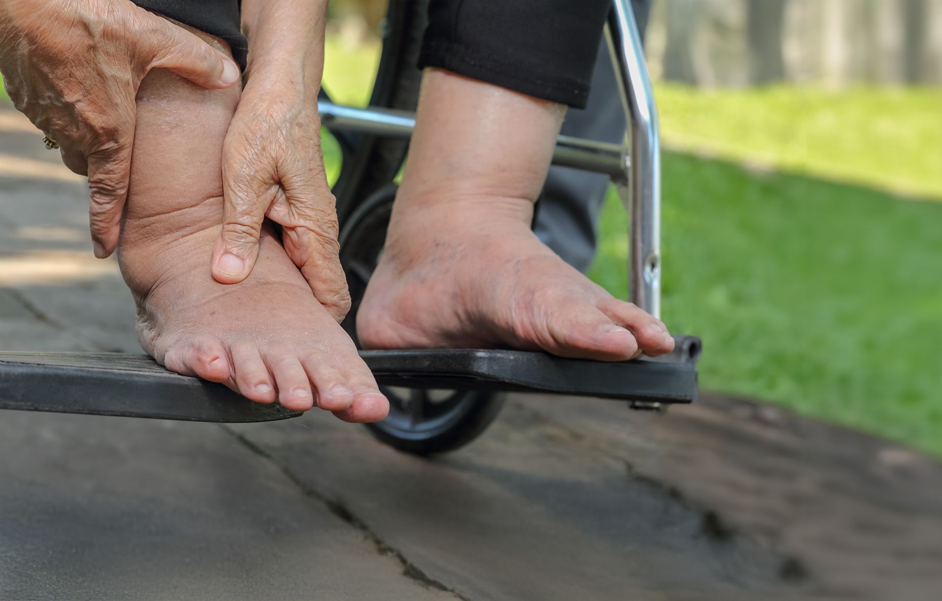 A woman in a wheelchair is holding her swollen foot.