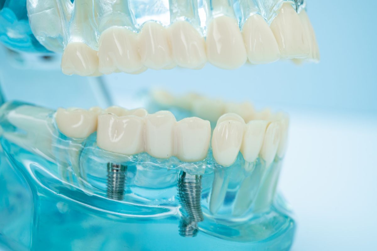 Dental model with upper and lower teeth, some with dental implants.