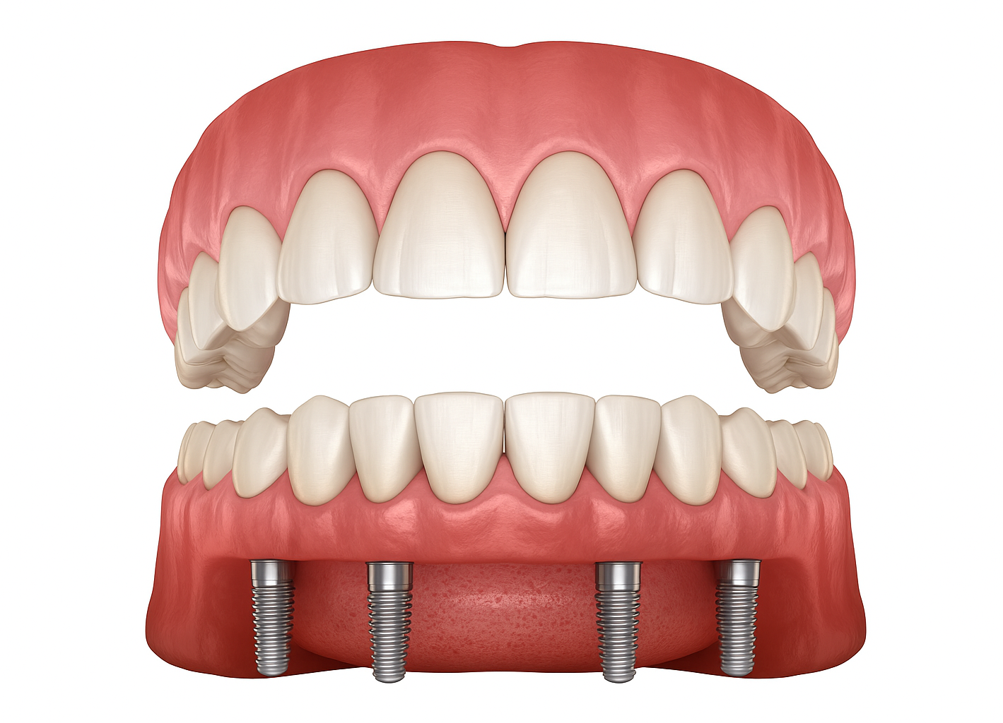 Illustration of dental implants supporting a full set of artificial teeth; pink gums, white teeth.