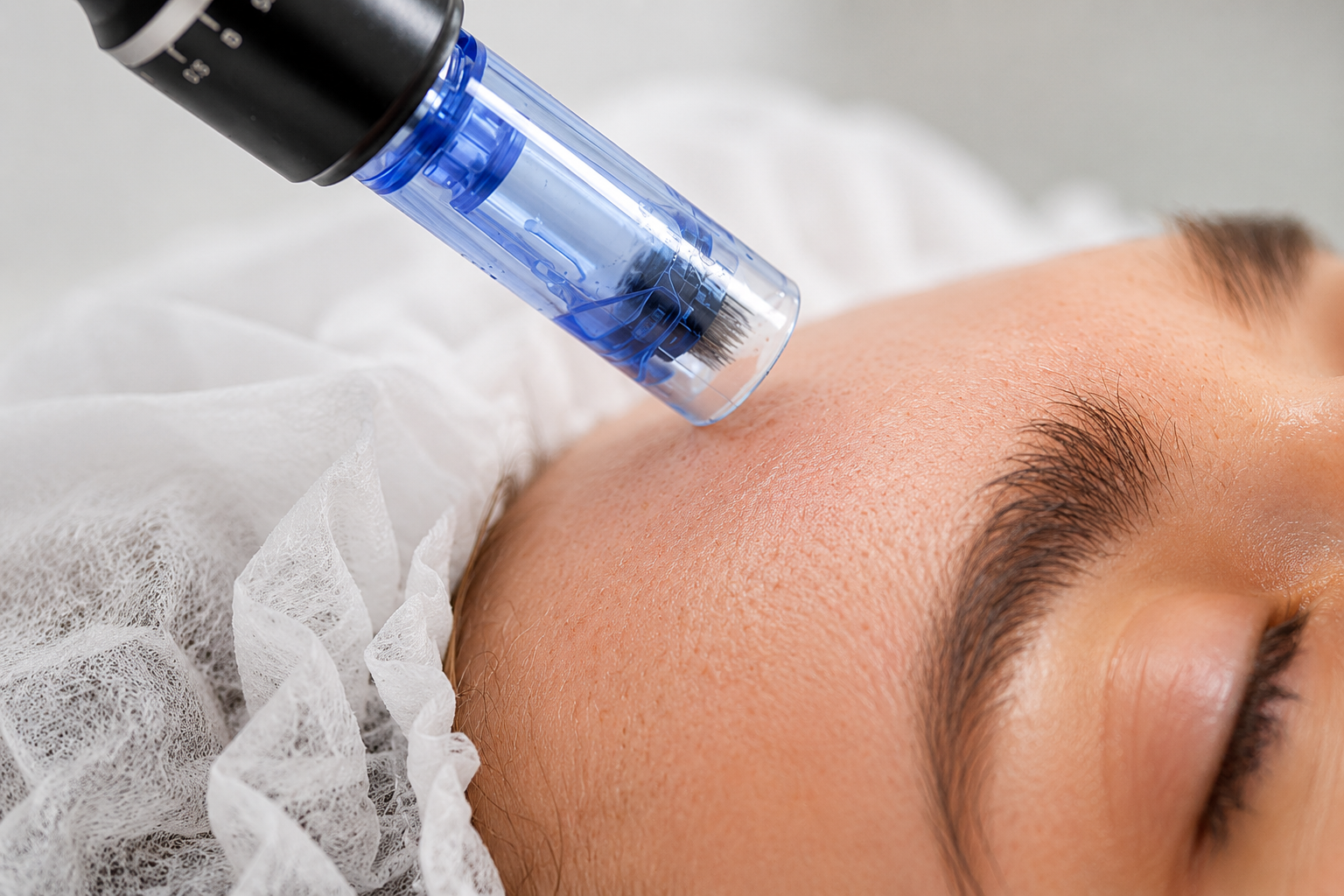 Microneedling device treating a woman’s forehead in a spa setting