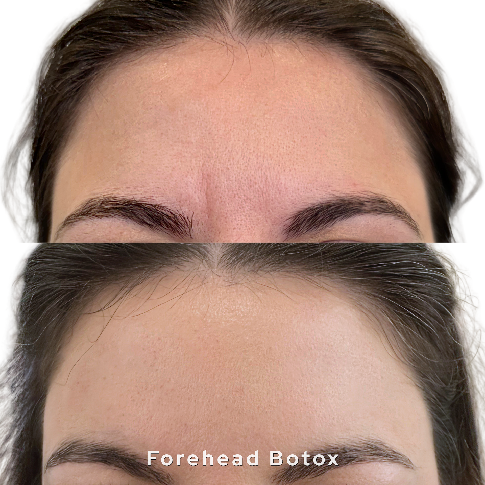 Close-up of forehead with makeup-free skin, labeled “Forehead Botox”