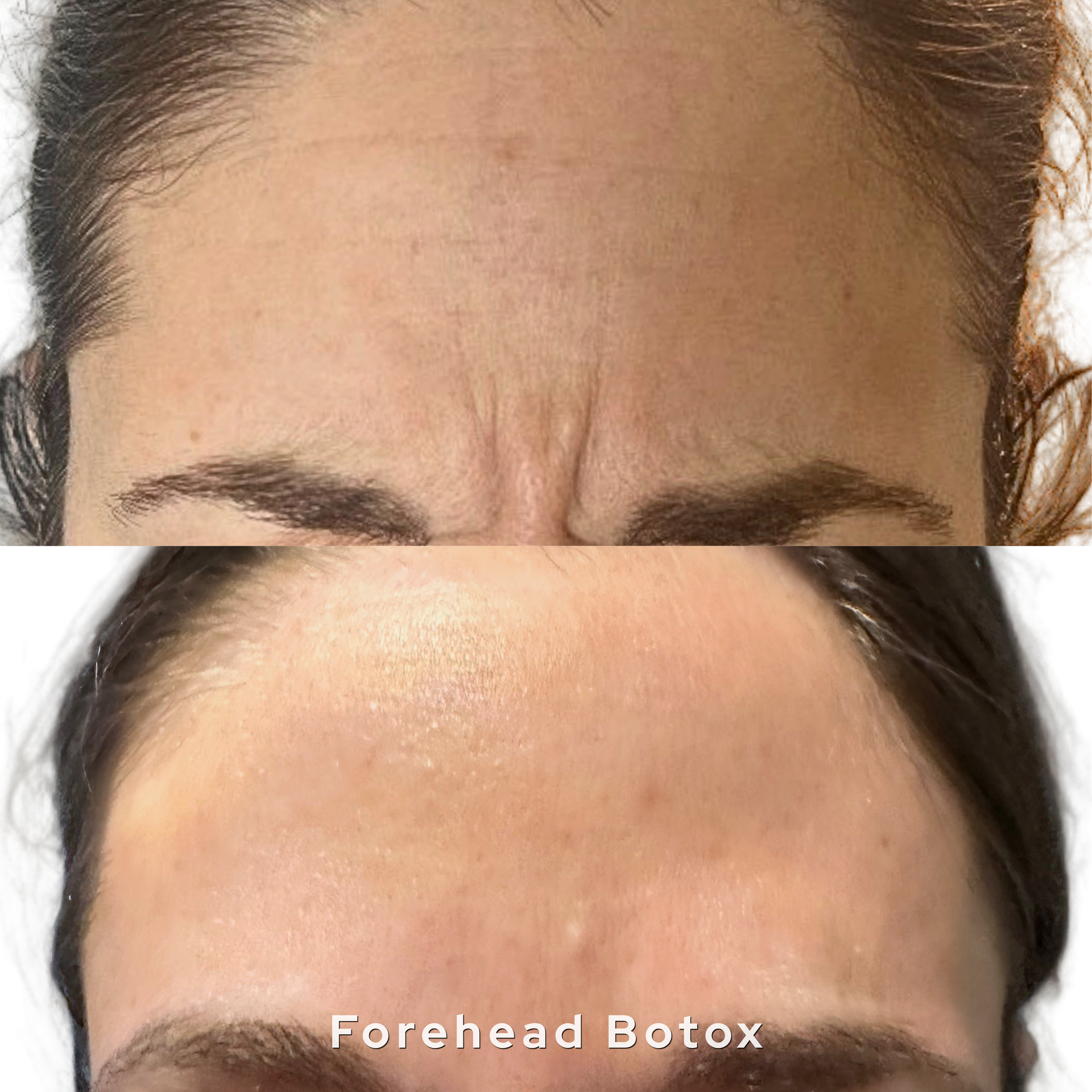 Forehead before-and-after comparison showing smoothing after Botox treatment
