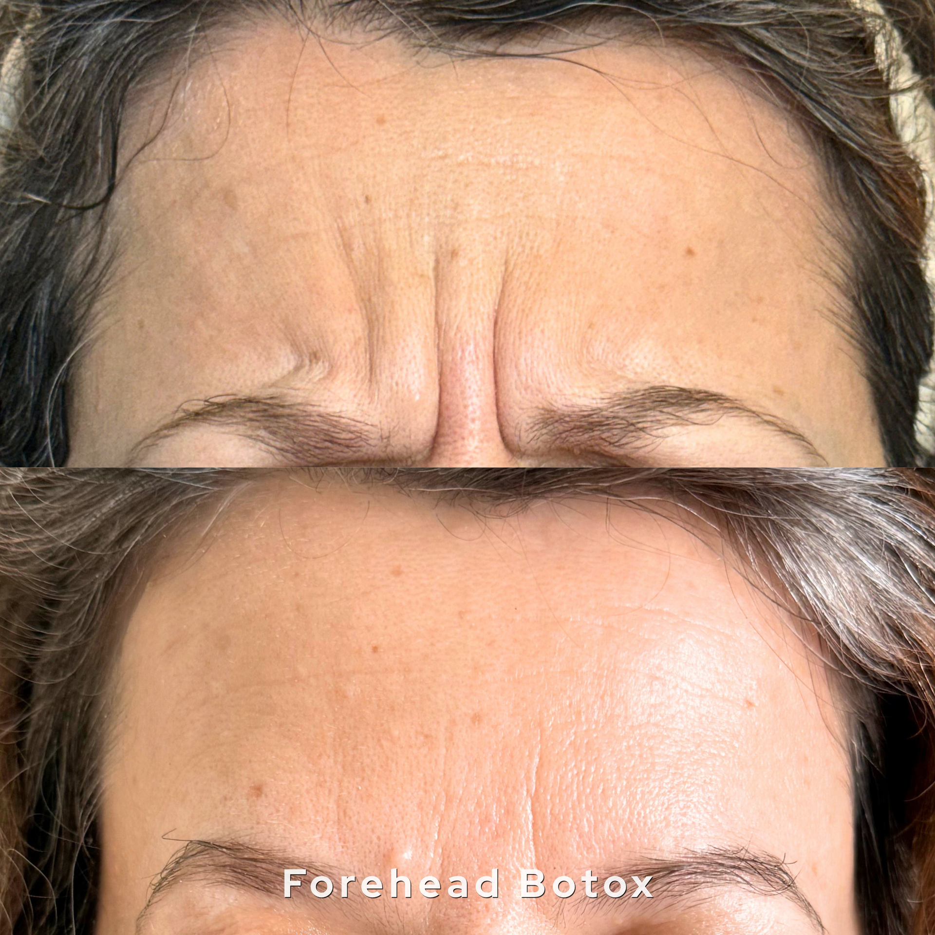 Close-up of a forehead with wrinkles and a dark band across it, labeled “Forehead Botox”