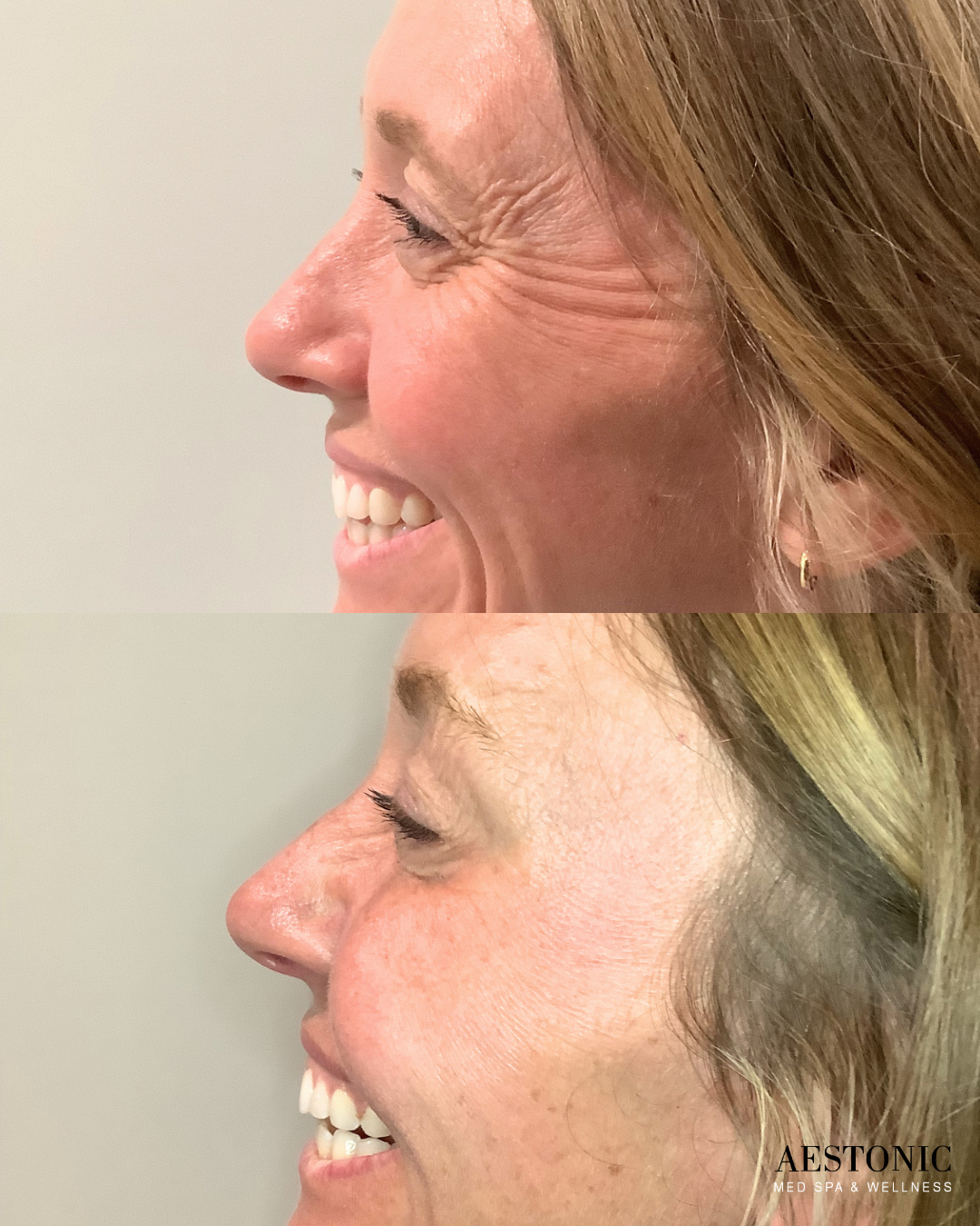 Two smiling profiles stacked vertically, shown from the side against a plain light background.