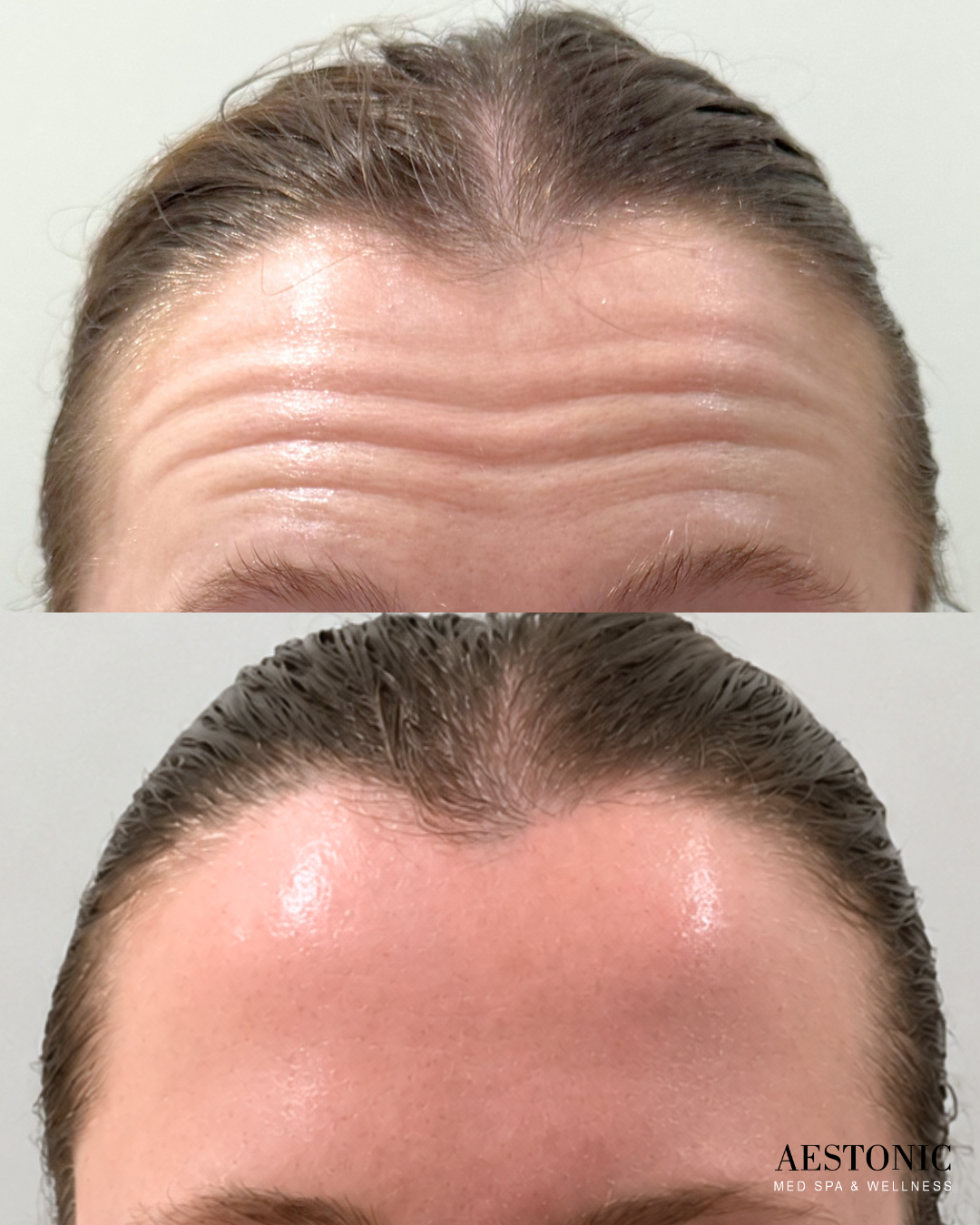 Forehead before-and-after: deep horizontal wrinkles change to smoother skin.