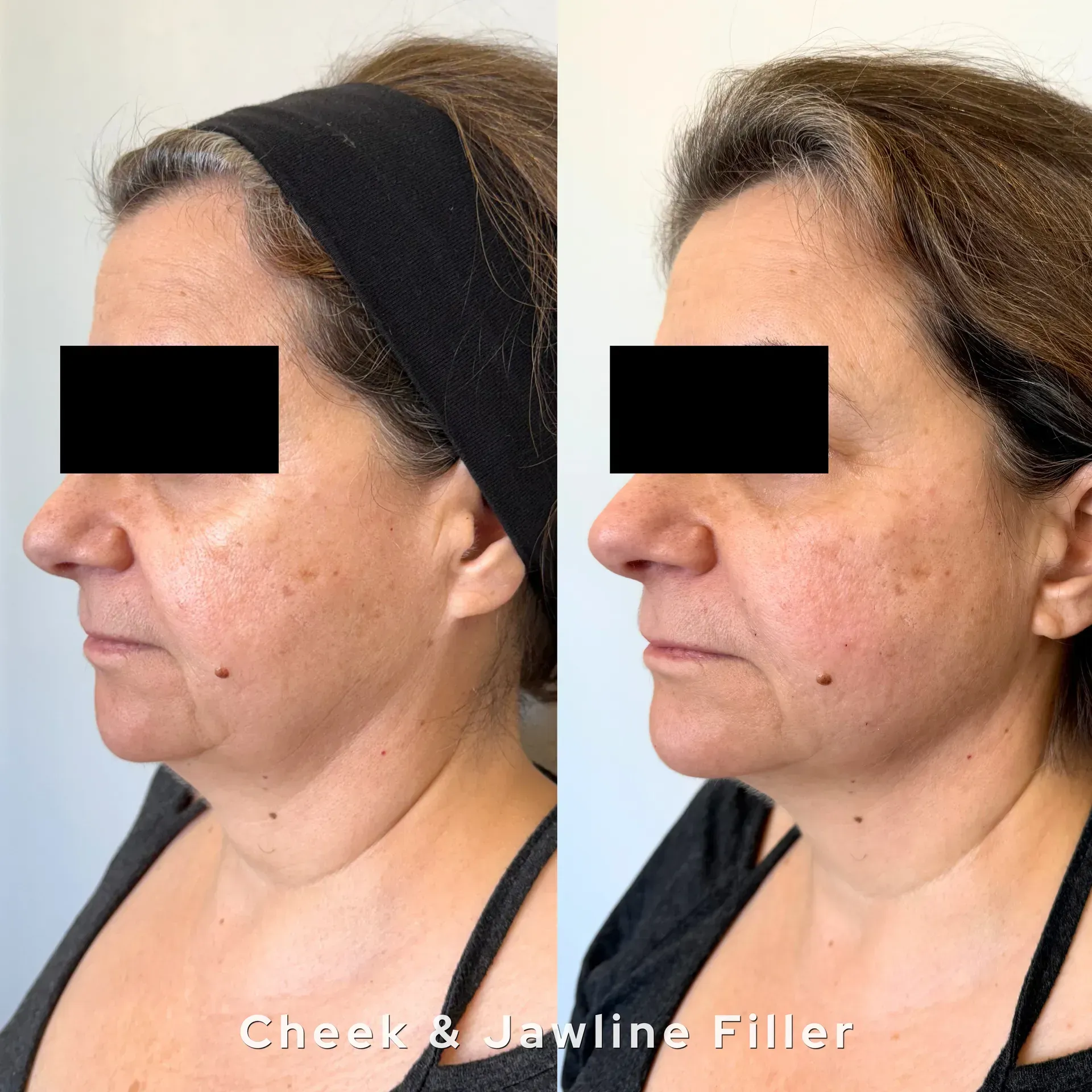 Side-by-side profile photos showing a woman’s cheek and jawline before and after filler treatment