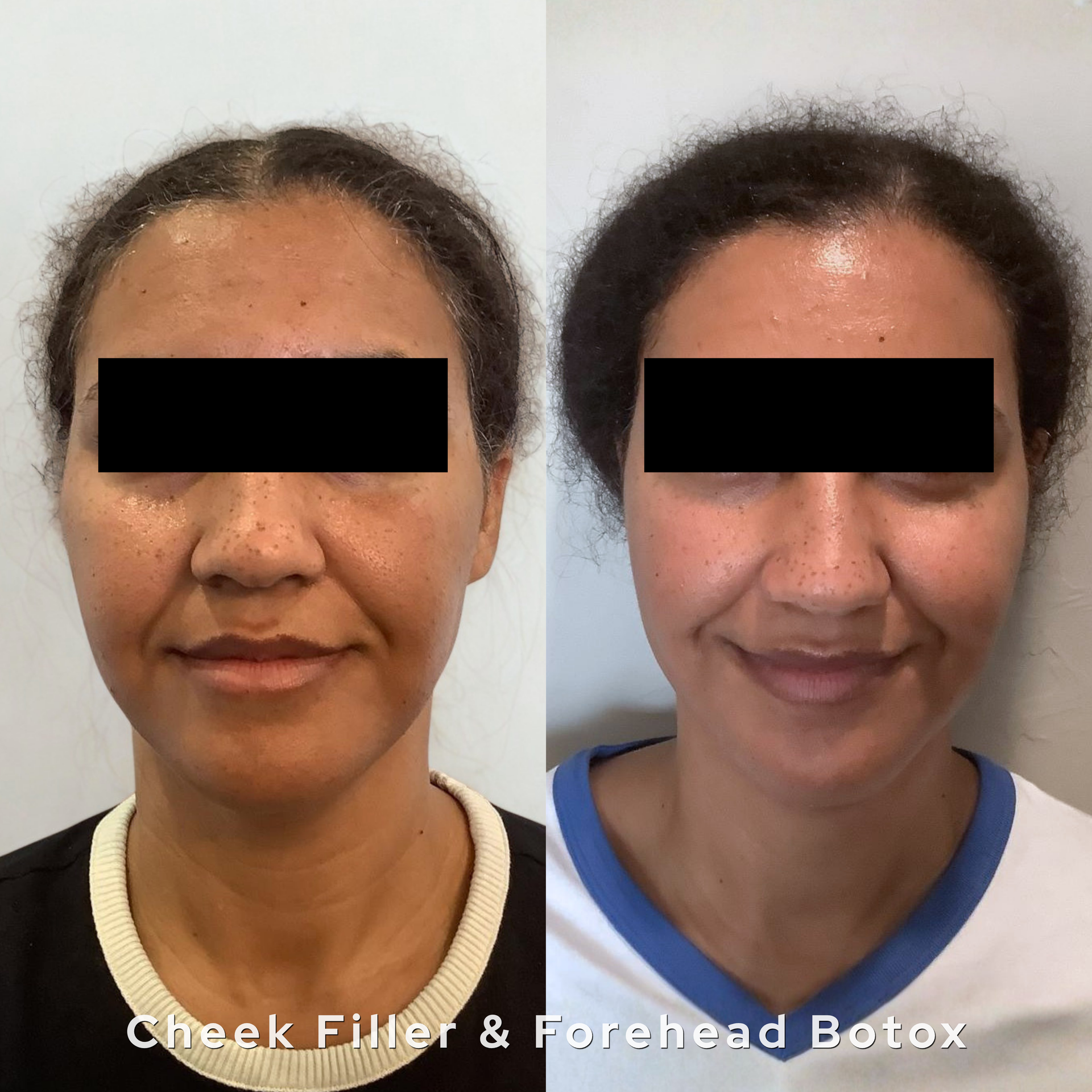 Side-by-side portrait of a woman before and after cheek filler and forehead Botox treatments.
