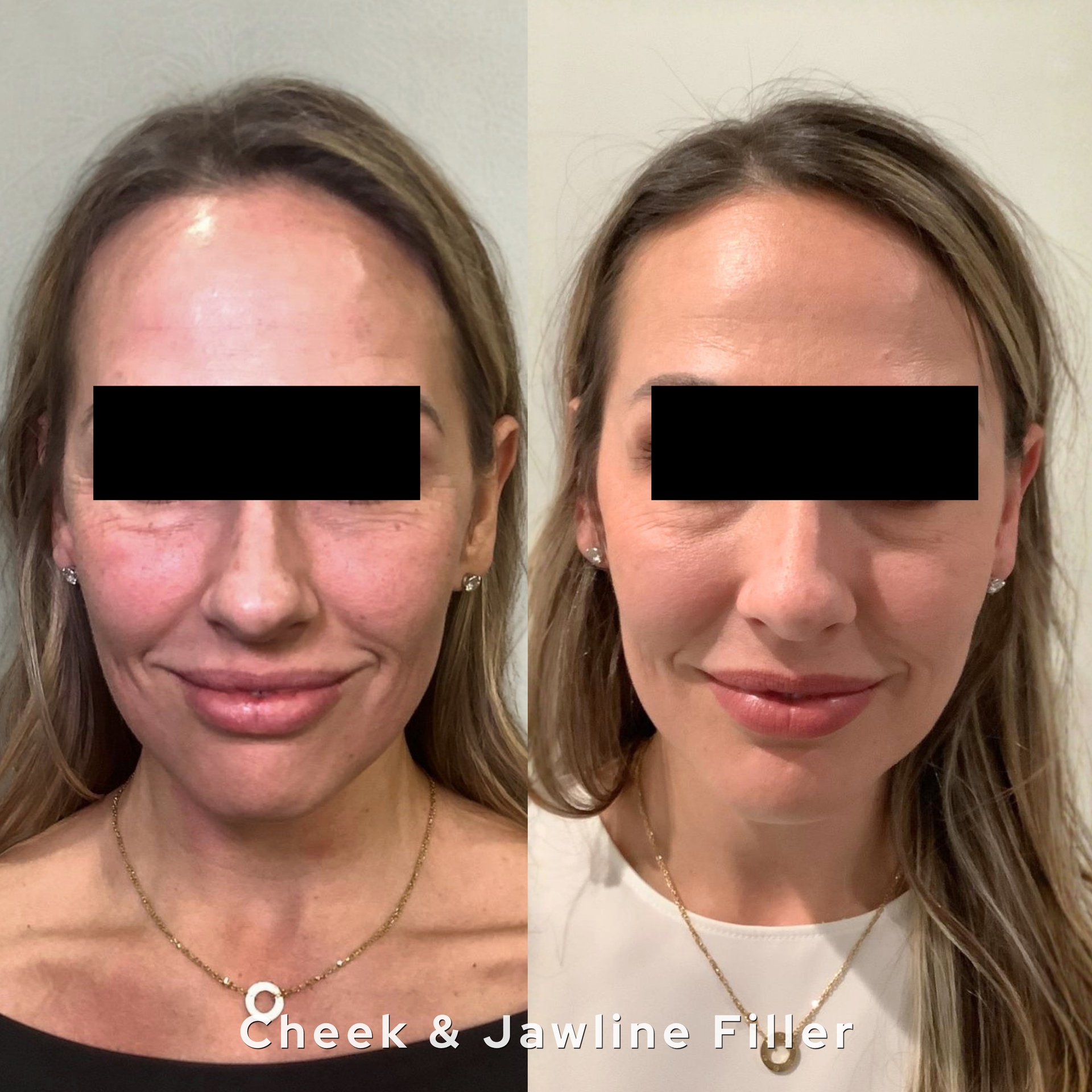 Before-and-after facial filler comparison showing a smoother cheek and jawline profile.