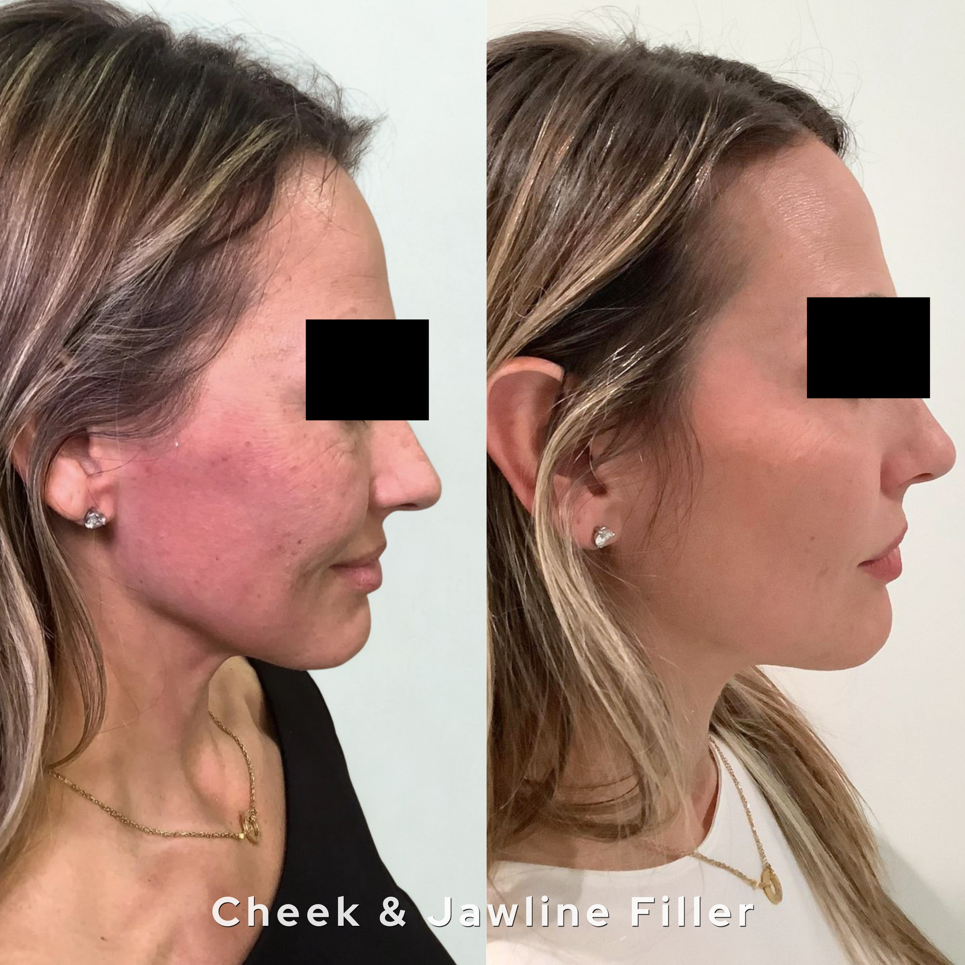 Side-by-side profile photos showing a cheek and jawline filler before and after treatment.