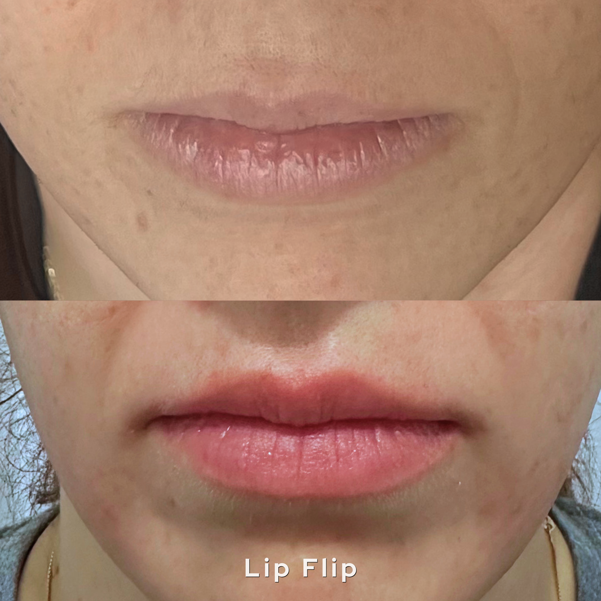 Split before-and-after close-up of lips, showing a lifted lower lip labeled “Lip Flip.”