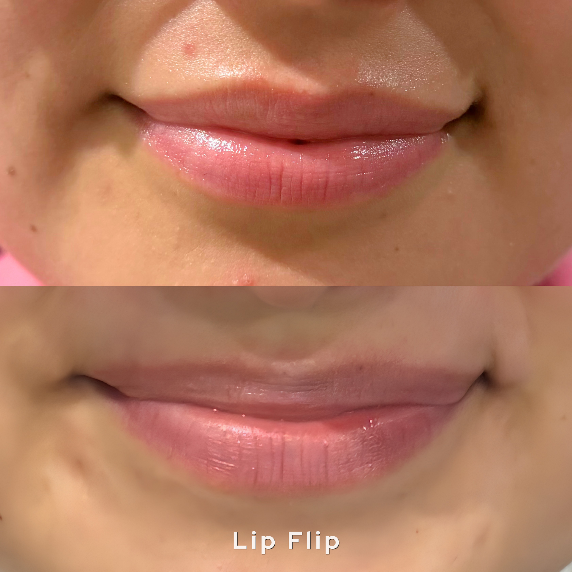 Close-up of lips before and after a lip flip, showing a subtle upward curl.