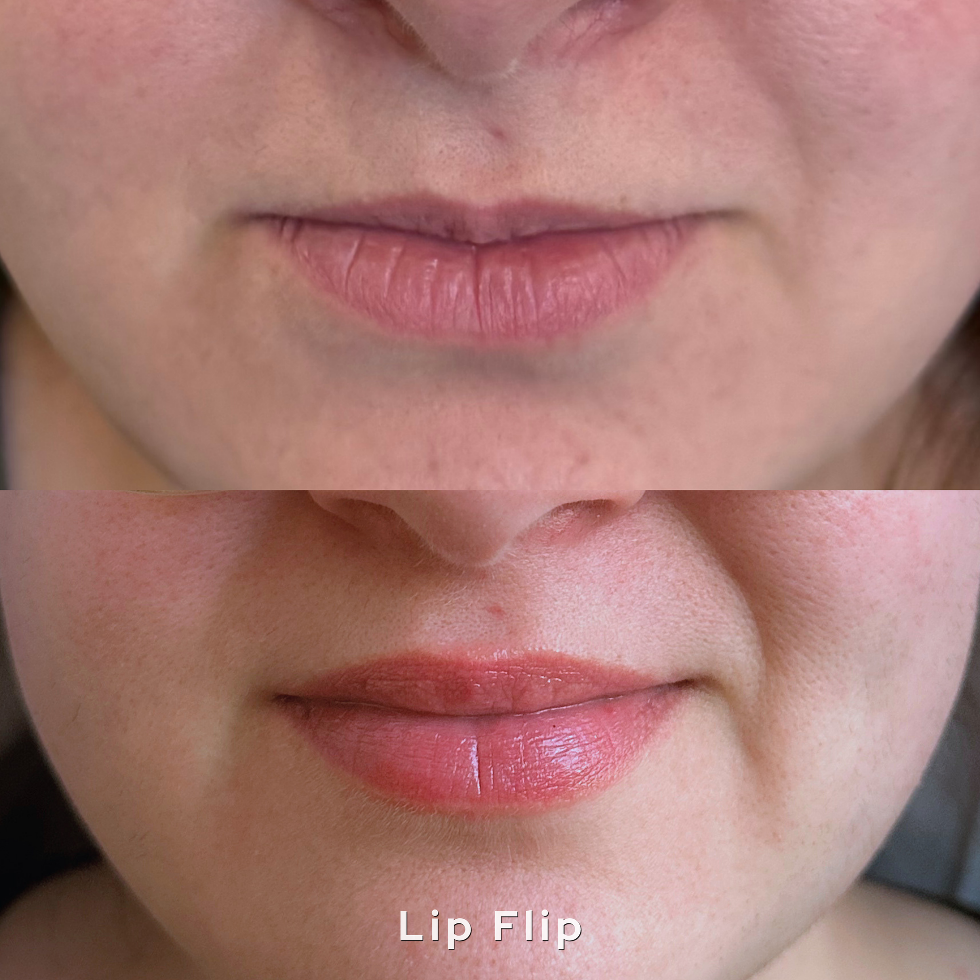 Close-up of lips before and after lip flip, showing a more lifted upper lip on the bottom.