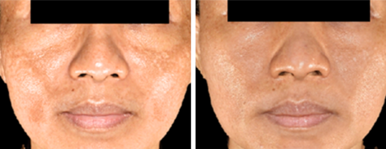Side-by-side facial close-ups showing skin tone changes and reduced dark spots on the right