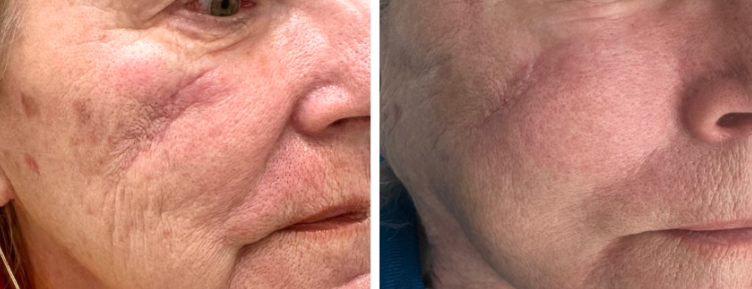 Side-by-side close-up of a face before and after treatment, showing smoother skin and reduced wrinkles