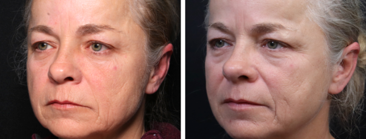 Side-by-side close-up portrait showing a woman before and after cosmetic treatment, with smoother skin on the right.
