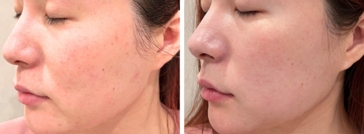 Side-by-side close-up profile photos of a woman’s face showing before and after skin appearance