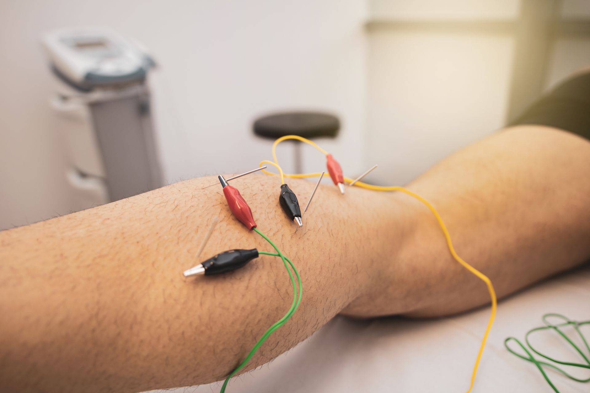 A leg with acupuncture needles attached to wires. The setting is indoors.