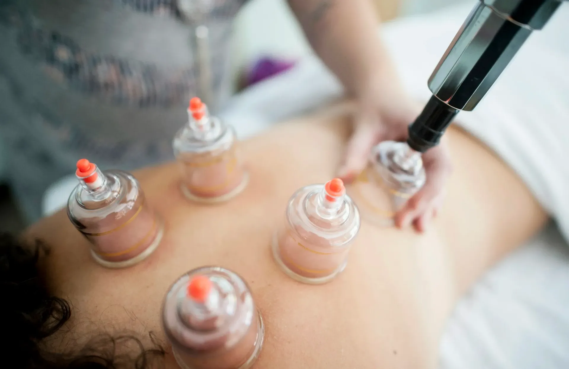 Person receiving cupping therapy on their back with red-tipped glass cups.
