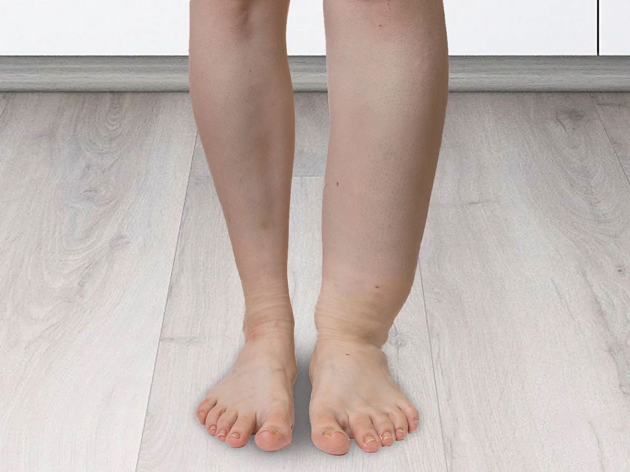 a person with a swollen leg is standing on a wooden floor