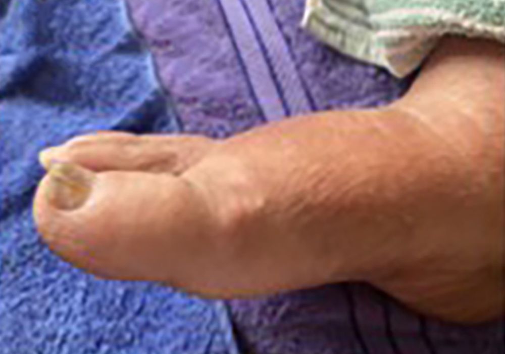 after manual lymphatic drainage massage