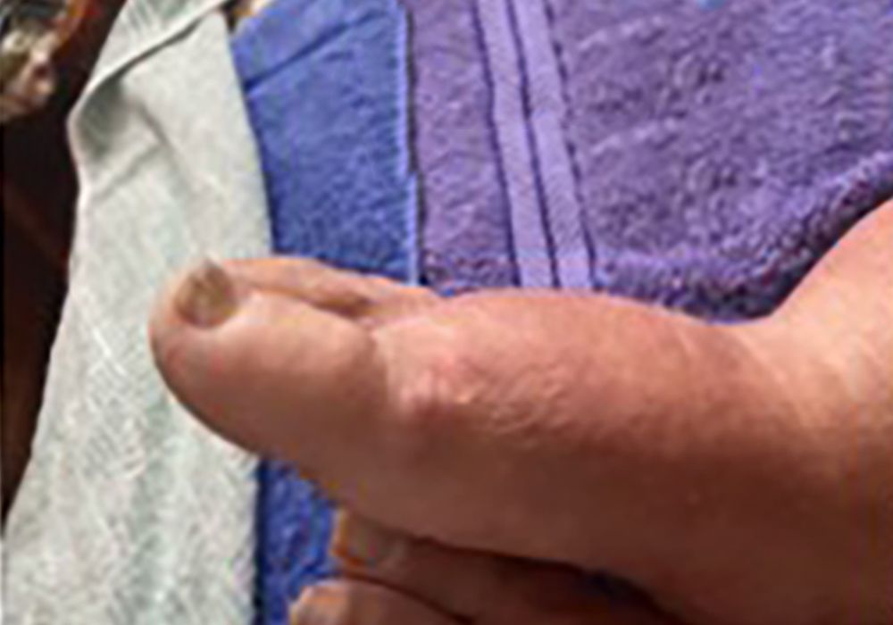 before manual lymphatic drainage massage