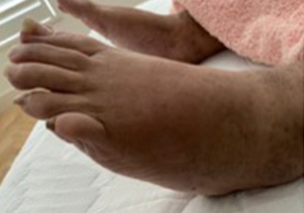 after manual lymphatic drainage massage on foot