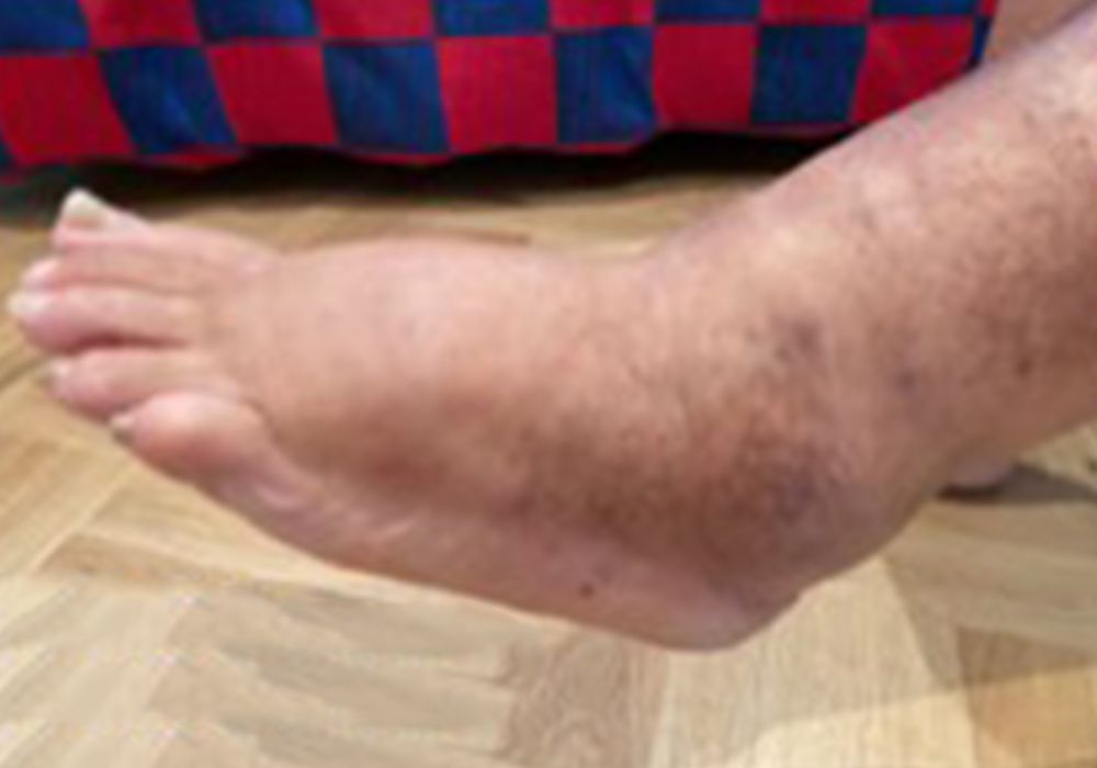 a person with lymphoedema