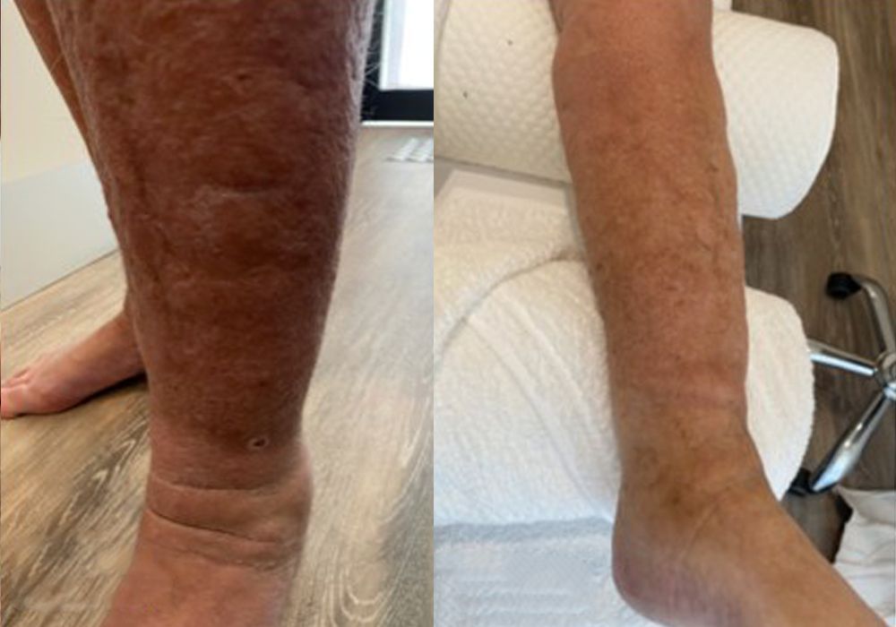 person with lymphoedema stage II before treatment