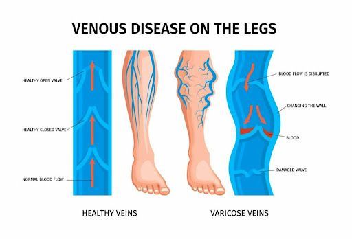 a diagram of venous disease on the legs showing healthy veins and varicose veins