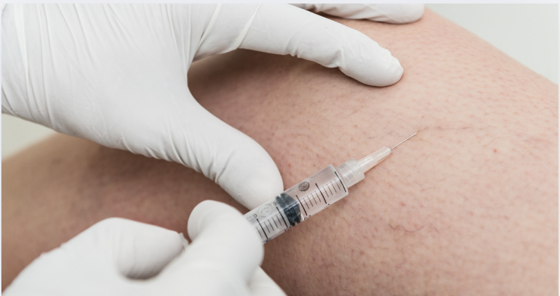 Sclerotherapy for spider veins