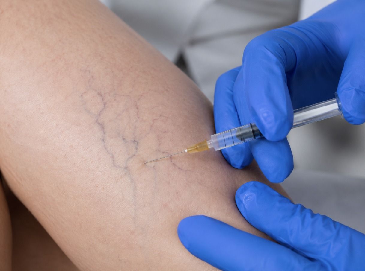 Main Spider Vein Treatment Options