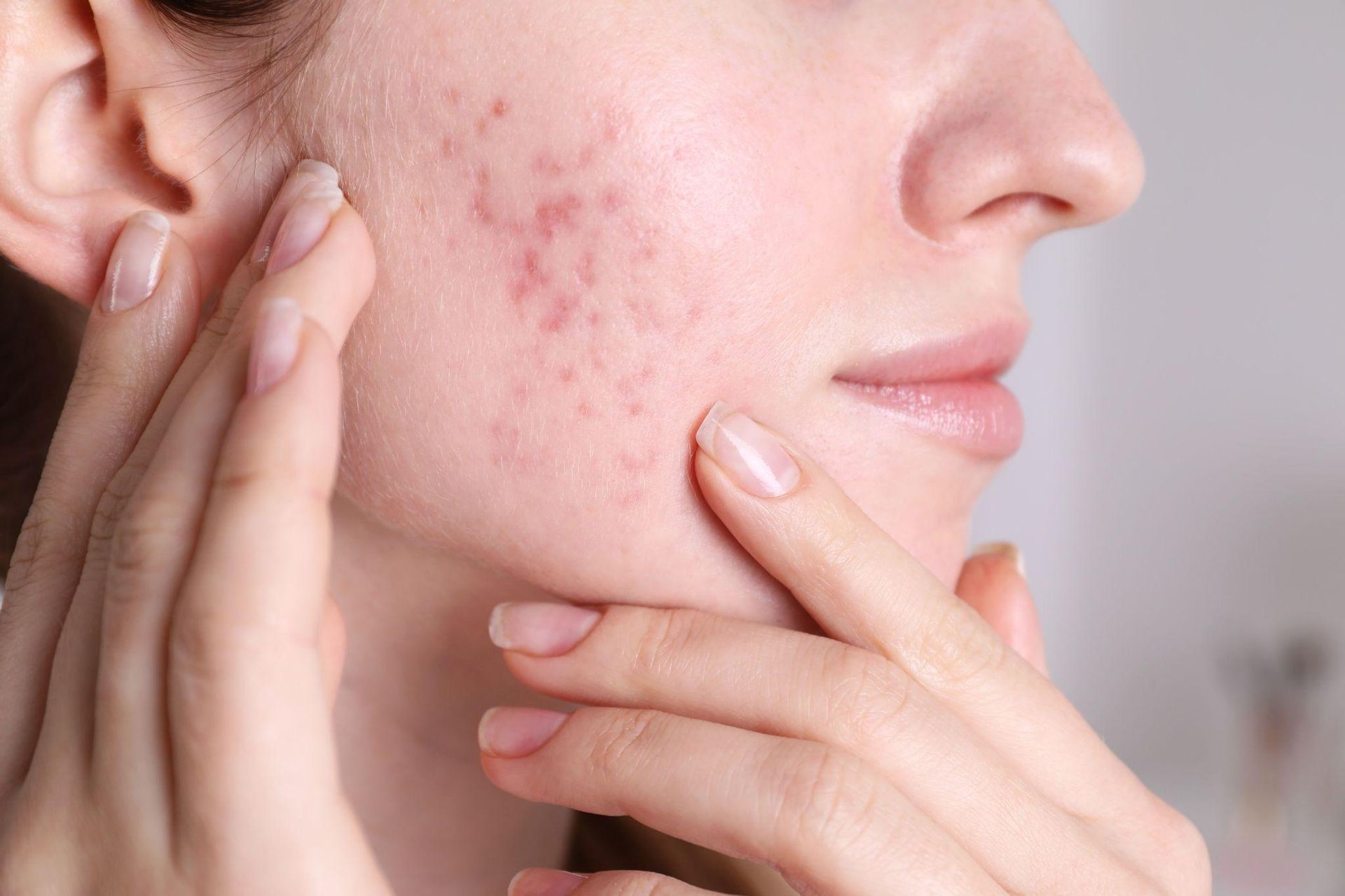 Understanding Acne Scars: What Causes Them and Why They Stick Around