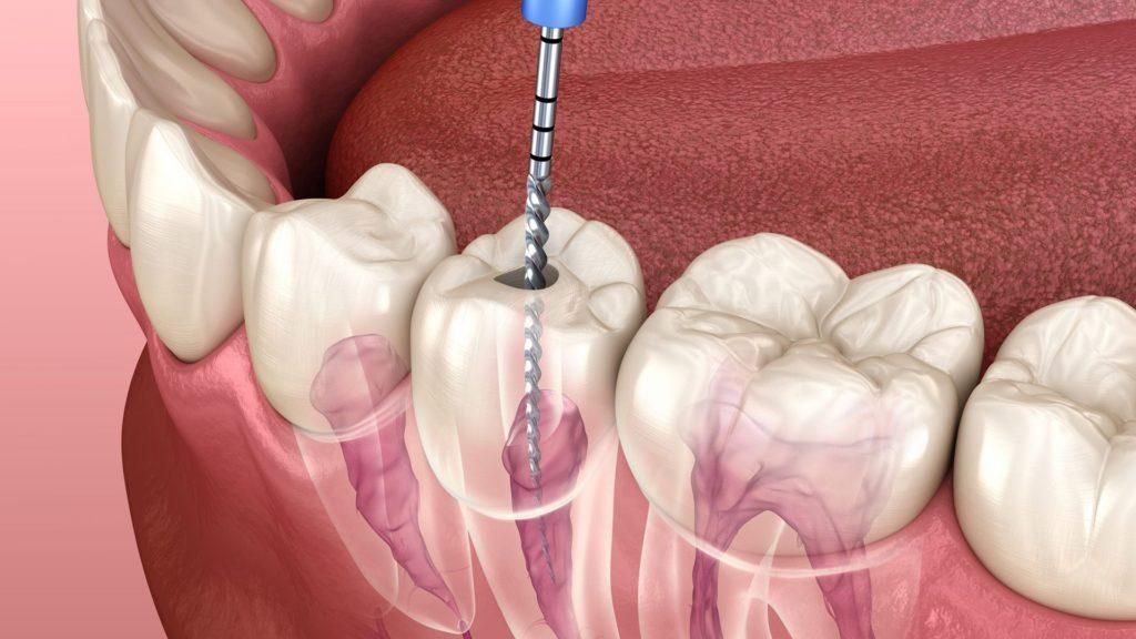 endodonzia