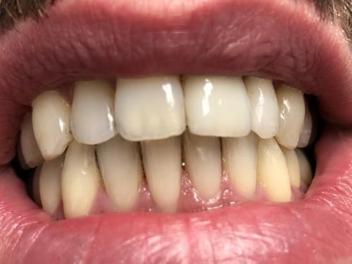 Un primo piano dei denti - trattamenti conservativa