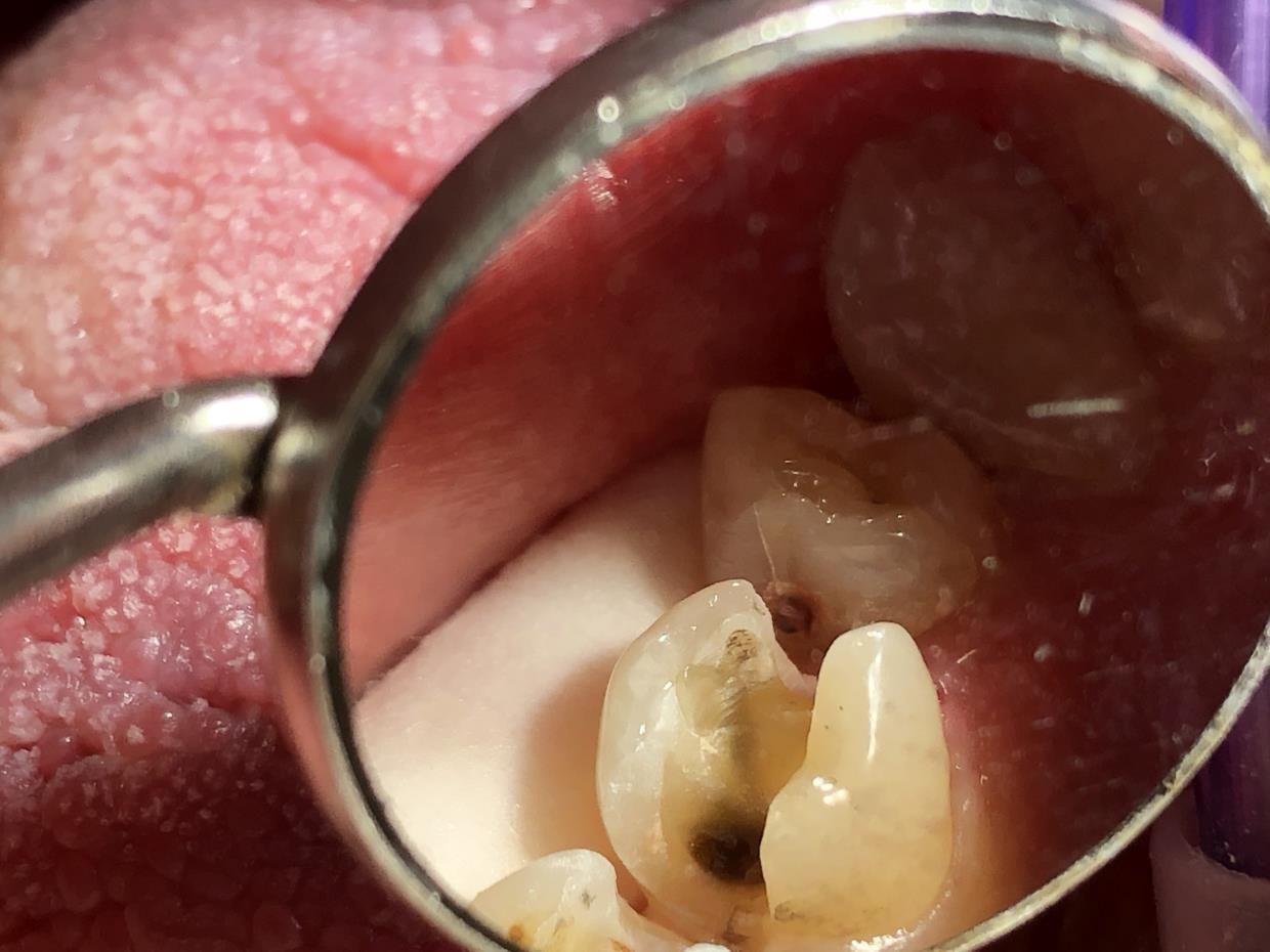 Un primo piano dei denti - trattamenti conservativa